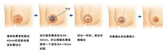 上海鼻翼缩小手术多少钱,术后效果自然吗