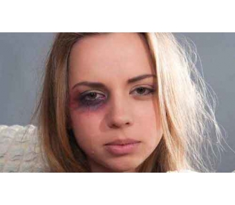 上海激光祛斑后反黑风险有吗，祛斑后如何护理