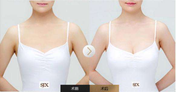 上海玻尿酸注射丰下巴能维持多久啊,常见的后遗症有哪些