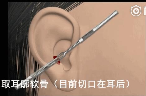 上海美莱吴海龙主任晋级“金刀赛”总决赛