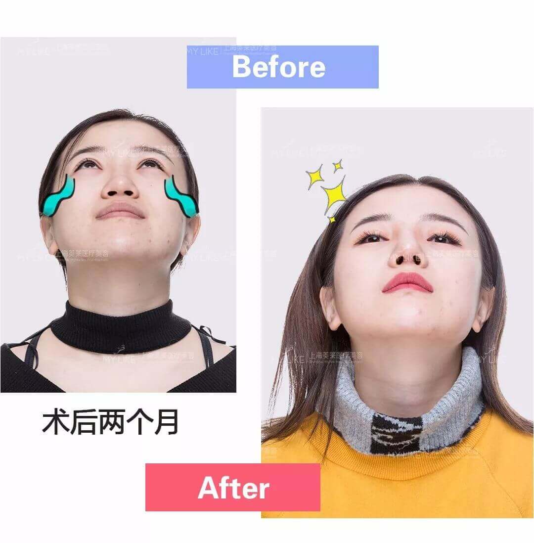 上海注射除皱医院哪家好,安全吗