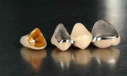 上海做牙齿美白有哪些注意事项呢