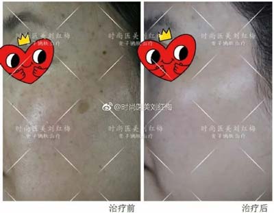 上海打玻尿酸隆鼻多少钱?怎么收费的