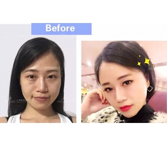 上海开眼角的恢复期一般大概是多久?