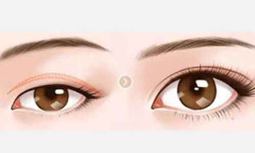 上海割双眼皮留下的疤痕是白色的,该怎么办?