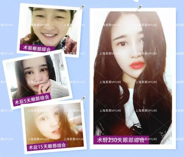 上海激光脱唇毛之后还会不会再“长”出来?