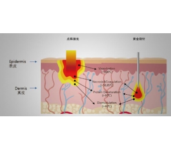 美莱整形鼻孔需要住院吗?