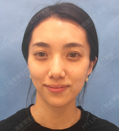 上海较久脱毛有什么副作用嘛