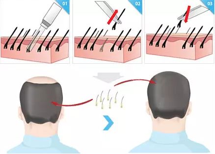 有哪些除皱方式可以维持童颜？