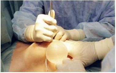 上海隆胸医院隆胸使用的材料都有保质期吗