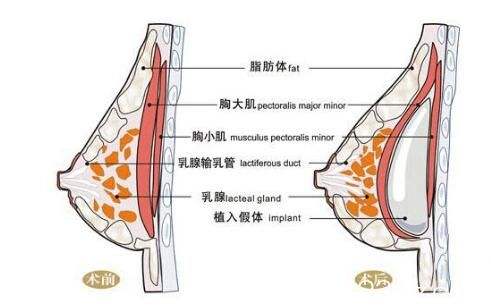 上海隆胸医院隆胸使用的材料都有保质期吗