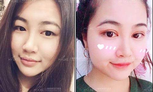 美莱:时间久了为什么埋线双眼皮会掉呢