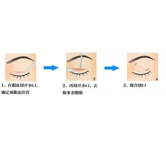上海开眼角有疤痕怎么办?