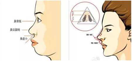 美莱吸脂去眼袋会反弹吗?