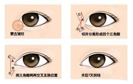 美莱老年斑能去除吗,如何去除的?