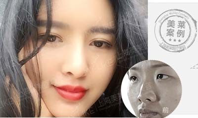 瘦脸面部吸脂好?还是瘦脸针好?