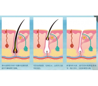 上海抽脂瘦肚子多少钱?