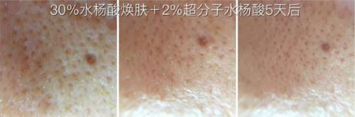 水光嫩肤适合什么年龄,有年龄“限制”吗?