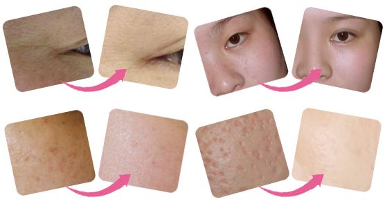 上海抽脂减肥大概收费多少?