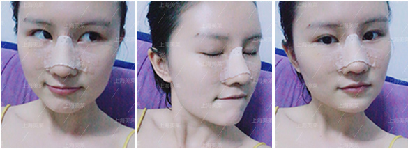 上海抽脂减肥大概收费多少?