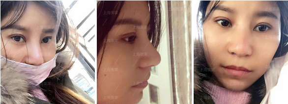 美莱开眼角的效果怎么样,优势有哪些?