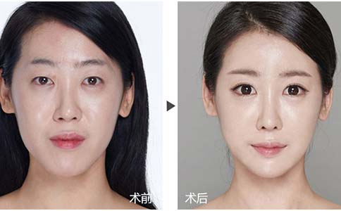 上海眼部除皱的好方法有几种?