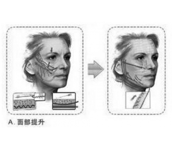 美莱假体隆鼻手术流程,是什么样子的