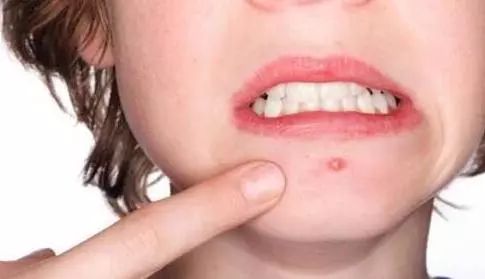 美莱面部自体脂肪填充效果怎么样,来了解一下!