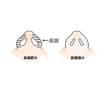 美莱打一次瘦脸针能管多久〢多可以注射几次