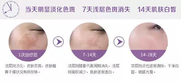 美莱做祛斑激光手术要多久,痛不痛?