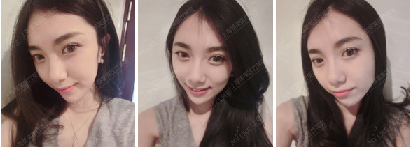 上海做吸脂哪家好,美莱腹部抽脂手术安全吗