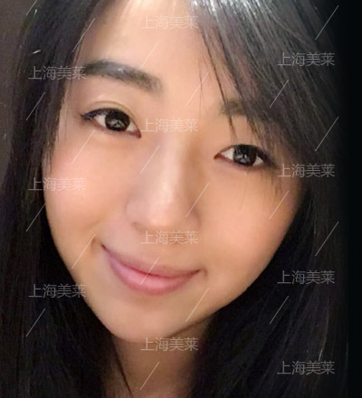 上海隆鼻医院注射玻尿酸隆鼻会有残留吗