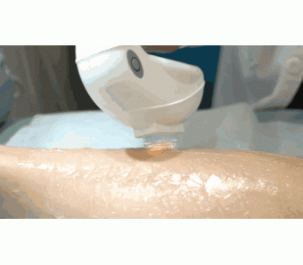 下巴后缩?美莱只需15分钟,轻松拯救小下巴!