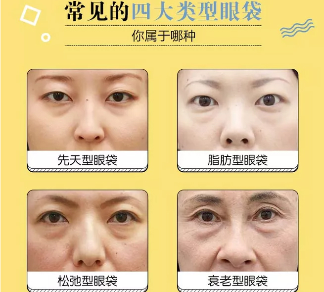 上海自体脂肪隆胸和假体隆胸哪个好,如何选择!