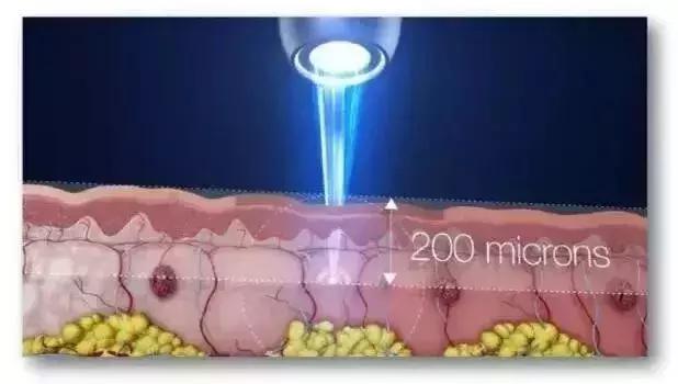 美莱蜂巢皮秒激光祛斑优势,快、狠、、准!