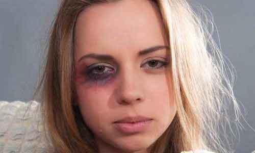 上海美莱做鼻翼缩小术后自然吗