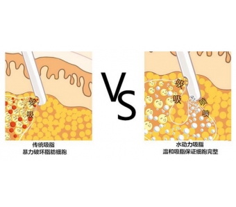 上海整形做自体脂肪隆胸费用需要多少