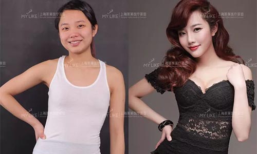 美莱PPDO线、PDO线跟蛋白线有什么区别?