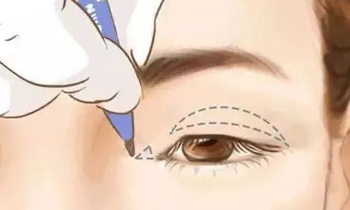 美莱隆鼻手术让你“改头换面”