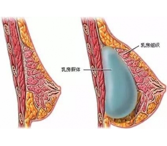 无针线雕做面部填充优势美莱有哪些？