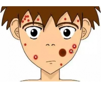 无针线雕做面部填充优势美莱有哪些？