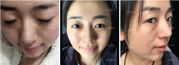 上海哪家医院做乳晕整形手术效果好