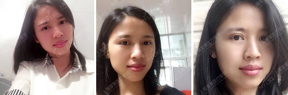 上海整形医院做自体脂肪丰胸贵不贵