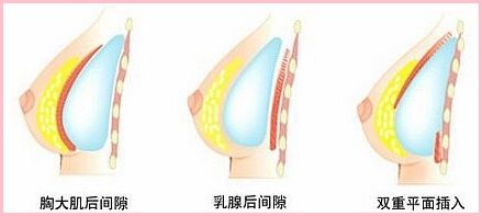 上海美莱医院做牙齿去除结石要多少钱?