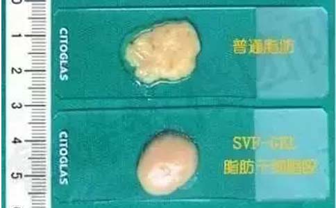 上海美莱医院做牙齿去除结石要多少钱?