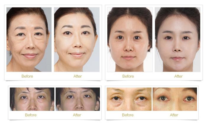 上海做激光去胎记是怎么收费的