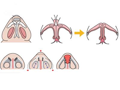 美莱彩光祛痘要做几次、几次效果才好?