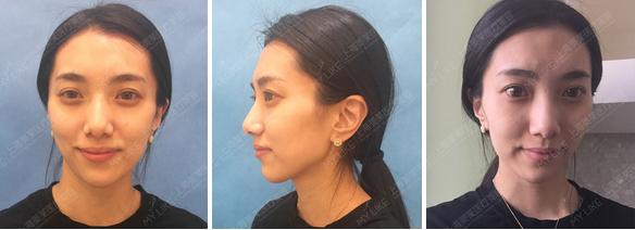 美莱彩光嫩肤美白效果如何