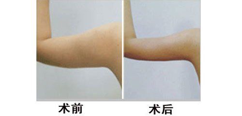 瘦脸的方法有几种↓美莱医生教你怎么选择瘦脸针!