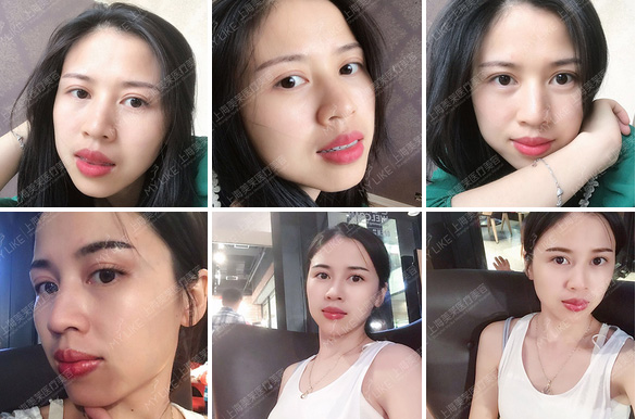 美莱隐形牙套很适合的特殊人群↓有哪些?